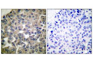 Immunohistochemical analysis of paraffin-embedded human breast carcinoma tissue using PLCG1 (epitope around residue 771) antibody (ABIN5976161).