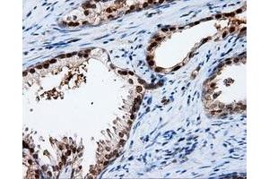 Immunohistochemical staining of paraffin-embedded Adenocarcinoma of ovary tissue using anti-APP mouse monoclonal antibody. (APP anticorps)