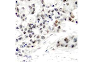 Immunohistochemistry of paraffin-embedded human breast carcinoma using Phospho-ESR1-S106 antibody (ABIN2988004). (Estrogen Receptor alpha anticorps  (pSer106))