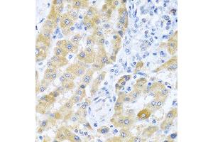 Immunohistochemistry of paraffin-embedded human liver cancer using Gm13125 antibody. (Pramel15 anticorps  (AA 67-274))