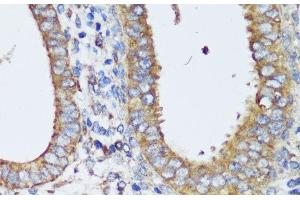 Immunohistochemistry of paraffin-embedded Human uterine cancer using ERK1 / ERK2 Polyclonal Antibody at dilution of 1:200 (40x lens). (ERK1/2 anticorps)