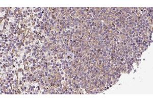 ABIN6273217 at 1/100 staining Human lymph cancer tissue by IHC-P. (CRLS1 anticorps  (Internal Region))