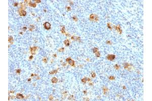 Formalin-fixed, paraffin-embedded human Hodgkin's Lymphoma stained with CD15 Rabbit Recombinant Monoclonal Antibody (FUT4/1478R).