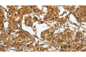 Immunohistochemistry of paraffin-embedded Human lung cancer tissue using AKAP12 Polyclonal Antibody at dilution 1:40 (AKAP12 anticorps)