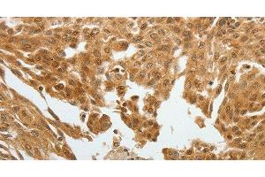 Immunohistochemistry of paraffin-embedded Human cervical cancer tissue using RETNLB Polyclonal Antibody at dilution 1:40 (RETNLB anticorps)
