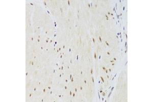 Immunohistochemistry of paraffin-embedded human gastric cancer using CSRP3 Antibody (ABIN2562048) at dilution of 1:100 (40x lens). (CSRP3 anticorps)