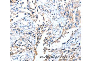 Immunohistochemistry of Human esophagus cancer using AOX1 Polyclonal Antibody at dilution of 1:65 (AOX1 anticorps)