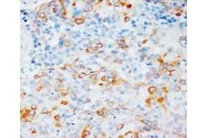 Immunohistochemical analysis of paraffin embedded ESCC sections, staining VEGF in cytoplams, DAB chromogenic reaction (VEGFA anticorps  (N-Term))