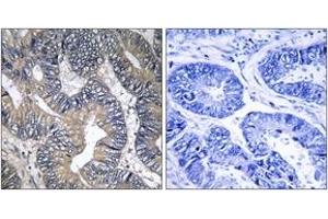 Immunohistochemistry analysis of paraffin-embedded human colon carcinoma tissue, using GTPBP2 Antibody. (GTPBP2 anticorps  (AA 31-80))