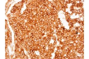 IHC-P Image Immunohistochemical analysis of paraffin-embedded HUH-7 xenograft, using TGR5, antibody at 1:100 dilution.