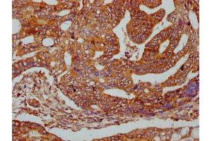 IHC image of ABIN7165895 diluted at 1:400 and staining in paraffin-embedded human colon cancer performed on a Leica BondTM system.