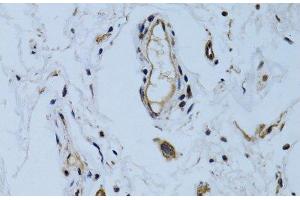 Immunohistochemistry of paraffin-embedded Human colon carcinoma using MCAM Polyclonal Antibody at dilution of 1:100 (40x lens). (MCAM anticorps)
