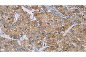 Immunohistochemistry of paraffin-embedded Human liver cancer using ACTN2 Polyclonal Antibody at dilution of 1:30