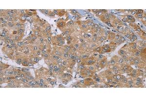 Immunohistochemistry of paraffin-embedded Human liver cancer using ACTN2 Polyclonal Antibody at dilution of 1:30 (ACTN2 anticorps)