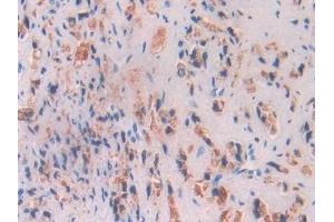 Detection of BCHE in Human Prostate cancer Tissue using Polyclonal Antibody to Butyrylcholinesterase (BCHE)