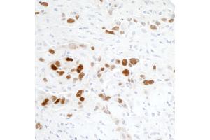 Immunohistochemistry (IHC) image for anti-Tumor Protein P53 (TP53) (AA 20-25) antibody (ABIN7455068) (p53 anticorps  (AA 20-25))