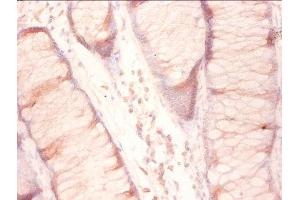 Immunohistochemistry of paraffin-embedded human colon cancer using ABIN7142788 at diluton of 1:50 (RPL27 anticorps  (AA 2-136))