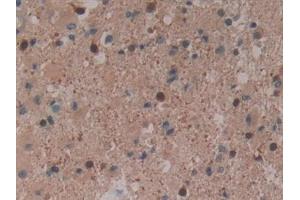 Detection of F13A1 in Human Glioma Tissue using Polyclonal Antibody to Coagulation Factor XIII A1 Polypeptide (F13A1)