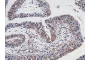 Detection of VEGF121 in Human Liver Cancer Tissue using Monoclonal Antibody to Vascular Endothelial Growth Factor 121 (VEGF121)