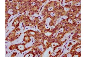 IHC image of ABIN7160335 diluted at 1:200 and staining in paraffin-embedded human liver cancer performed on a Leica BondTM system.