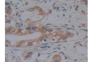 Detection of KDM4A in Human Bile duct cancer Tissue using Polyclonal Antibody to Lysine Specific Demethylase 4A (KDM4A) (KDM4A anticorps  (AA 141-310))