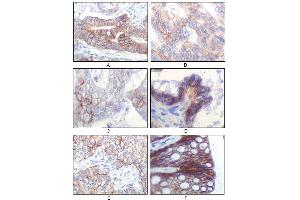 Immunohistochemical analysis of paraffin-embedded human gastric adenocarcinoma(A), colon adenocarcinoma(B), endometrial carcinoma(uterus)(C), ovary adenocarcinoma(D), lung squamous cell carcinoma(E), stomach epithelium mucosae(F), showing membrane localization using IGF1R antibody with DAB staining. (IGF1R anticorps)