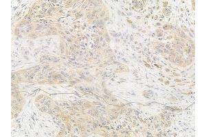 ABIN6256096 and ABIN6267277 at 1/100 staining human tongue carcinoma by IHC-P. (Estrogen Receptor alpha anticorps  (pSer106))