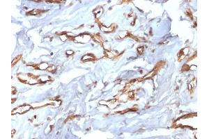 Formalin-fixed, paraffin-embedded human Angiosarcoma stained with CD34 Recombinant Rabbit Monoclonal Antibody (HPCA1/2598R). (Recombinant CD34 anticorps)