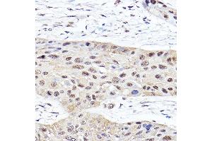 Immunohistochemistry of paraffin-embedded human esophageal cancer using PSMB2 Rabbit pAb (ABIN6129442, ABIN6146314, ABIN6146316 and ABIN6221150) at dilution of 1:100 (40x lens). (PSMB2 anticorps  (AA 1-201))