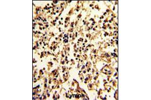 Formalin-fixed and paraffin-embedded human lymph with SERPINA9 Antibody , which was peroxidase-conjugated to the secondary antibody, followed by DAB staining. (SERPINA9 anticorps  (AA 194-222))