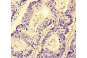 Immunohistochemistry of paraffin-embedded human colon cancer using ABIN7161435 at dilution of 1:100 (NRP2 anticorps  (AA 60-209))