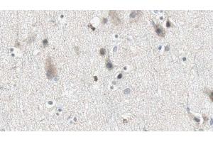 ABIN6274868 at 1/100 staining Human brain cancer tissue by IHC-P. (ARSG anticorps  (Internal Region))