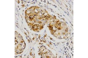Immunohistochemistry of paraffin-embedded human stomach cancer using OLR1 antibody at dilution of 1:200 (x400 lens). (OLR1 anticorps  (AA 58-273))