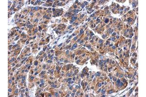 IHC-P Image Immunohistochemical analysis of paraffin-embedded human hepatoma, using GBA, antibody at 1:500 dilution. (GBA anticorps  (Center))