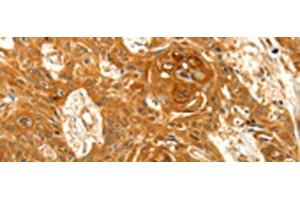 Immunohistochemistry of paraffin-embedded Human esophagus cancer tissue using VSNL1 Polyclonal Antibody at dilution of 1:25(x200)
