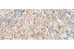 Immunohistochemistry of paraffin-embedded Human cervical cancer tissue using GTF3C2 Polyclonal Antibody at dilution of 1:45(x200)