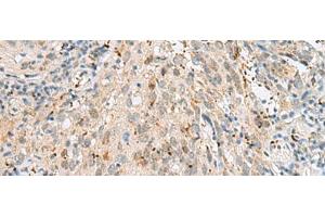 Immunohistochemistry of paraffin-embedded Human cervical cancer tissue using GTF3C2 Polyclonal Antibody at dilution of 1:45(x200) (GTF3C2 anticorps)