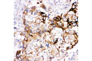 Anti- HMOX2 antibody, IHC(P) IHC(P): Human Lung Cancer Tissue (HMOX2 anticorps  (AA 2-316))