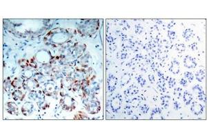 Immunohistochemical analysis of paraffin-embedded human breast carcinoma tissue using BIM(Phospho-Ser69) Antibody(left) or the same antibody preincubated with blocking peptide(right). (BIM anticorps  (pSer69))