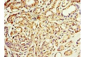 Immunohistochemistry of paraffin-embedded human breast cancer using ABIN7143649 at dilution of 1:100