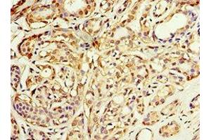 Immunohistochemistry of paraffin-embedded human breast cancer using ABIN7143649 at dilution of 1:100 (ADH1C anticorps  (AA 1-375))