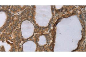 Immunohistochemistry of paraffin-embedded Human thyroid cancer using RNF5 Polyclonal Antibody at dilution of 1:35