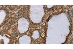Immunohistochemistry of paraffin-embedded Human thyroid cancer using RNF5 Polyclonal Antibody at dilution of 1:35 (RNF5 anticorps)