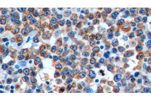 Detection of CD74 in Human Lymphoma Tissue using Polyclonal Antibody to Cluster Of Differentiation 74 (CD74)