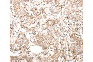 Immunohistochemical analysis of paraffin-embedded Human breast cancer tissue using at dilution 1/30. (CDH23 anticorps  (C-Term))