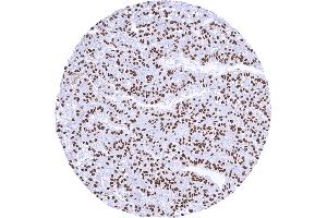 Strong nuclear TFE3 positivity in a renal cell carcinoma with TFE3 fusion