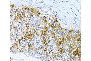 Immunohistochemistry of paraffin-embedded Human lung cancer using IFIT3 Polyclonal Antibody at dilution of 1:100 (40x lens). (IFIT3 anticorps)