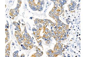 ABIN7094677 and ABIN7098728 at 1/100 staining Human breast cancer by IHC-P.