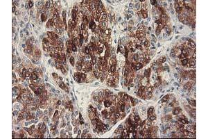 Immunohistochemical staining of paraffin-embedded Carcinoma of Human liver tissue using anti-CYP2C9 mouse monoclonal antibody. (CYP2C9 anticorps)