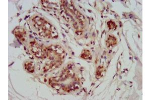 IHC image of ABIN7172782 diluted at 1:800 and staining in paraffin-embedded human breast cancer performed on a Leica BondTM system.